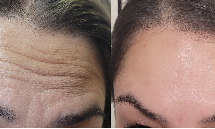 Image 7: Get Refreshed with 20, or 40 Units of Xeomin Injections 