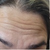 Image 7: Get Refreshed with 20, or 40 Units of Xeomin Injections 
