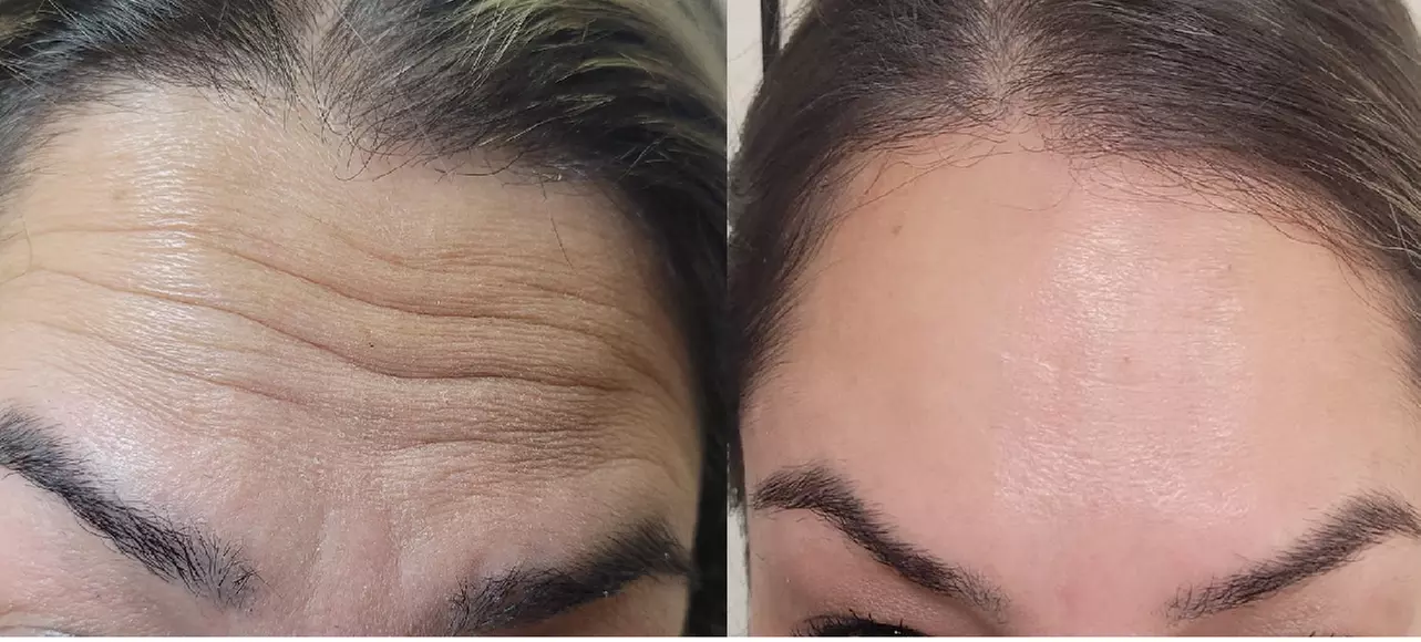 Get Refreshed with 20, or 40 Units of Xeomin Injections