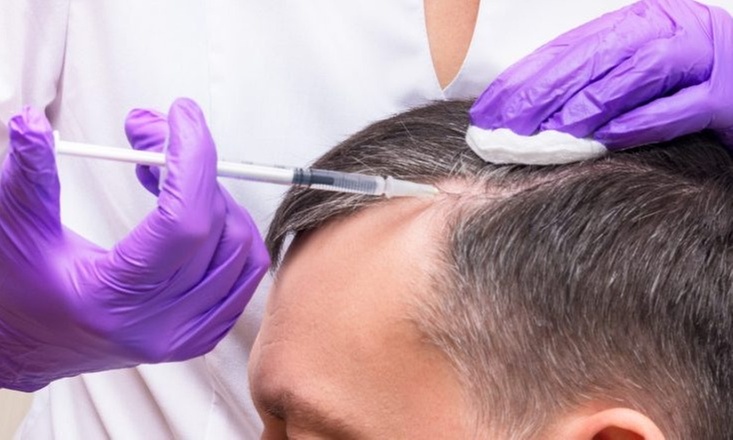Get 2,3 or 4 PRP Hair Restoration Treatments