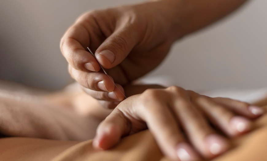 Image 2: 1 o 3 sesiones de acupuntura con opción a masaje tuina para 1 persona