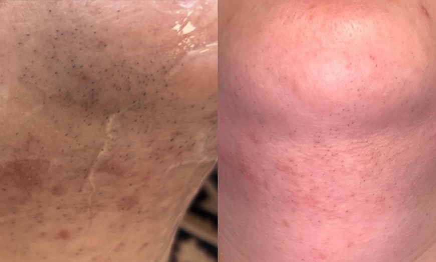 Image 4: Diodenlaser-Haarentfernung an verschiedenen Zonen für 1 Person