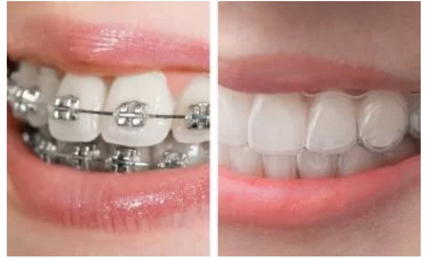 Image 3: Clear Aligners Or Invisalign With Dental Exam, X-Ray And Cleaning
