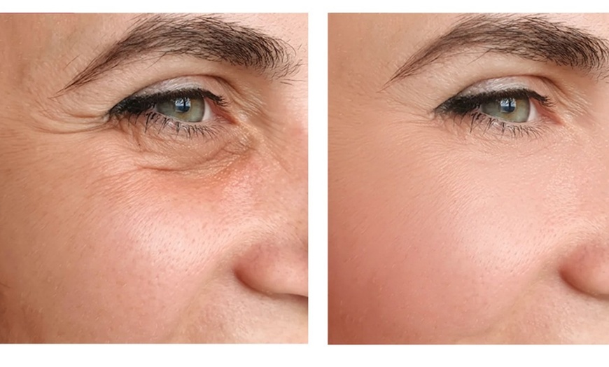 Image 2: Choice of Botox Injections