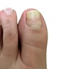 Image 2: Achieve Healthy Nails with 1 Laser Toenail Fungus Treatment