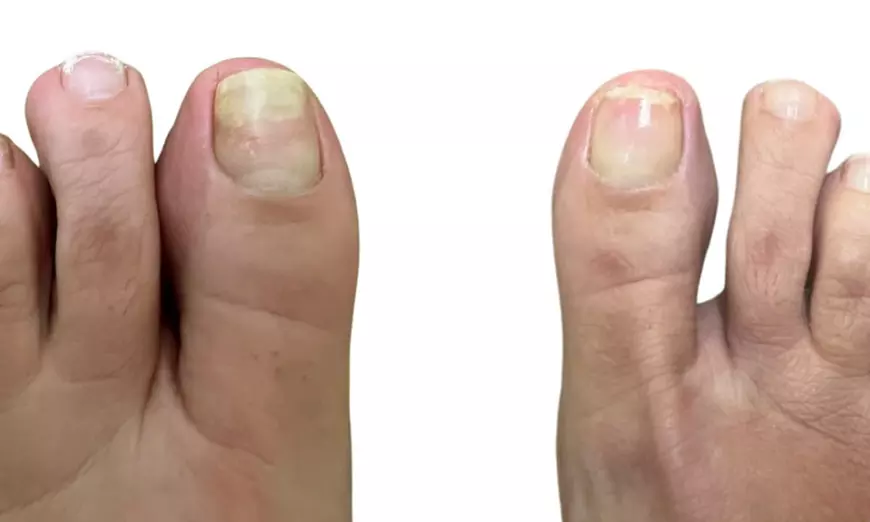 Achieve Healthy Nails with 1 Laser Toenail Fungus Treatment