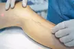 Up to 87% Off on Spider Vein Removal - Injection at Charming Skin Vein Center - Second Medium