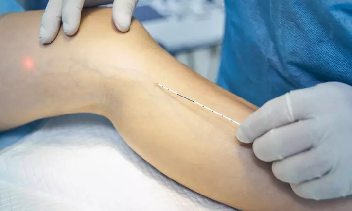 Up to 87% Off on Spider Vein Removal - Injection at Charming Skin Vein Center