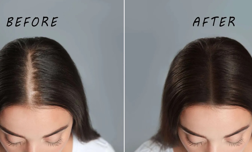 Image 5: Revive Your Glow: 1, 2 or 3 PRP Hair Loss or Facial Treatment Sessions