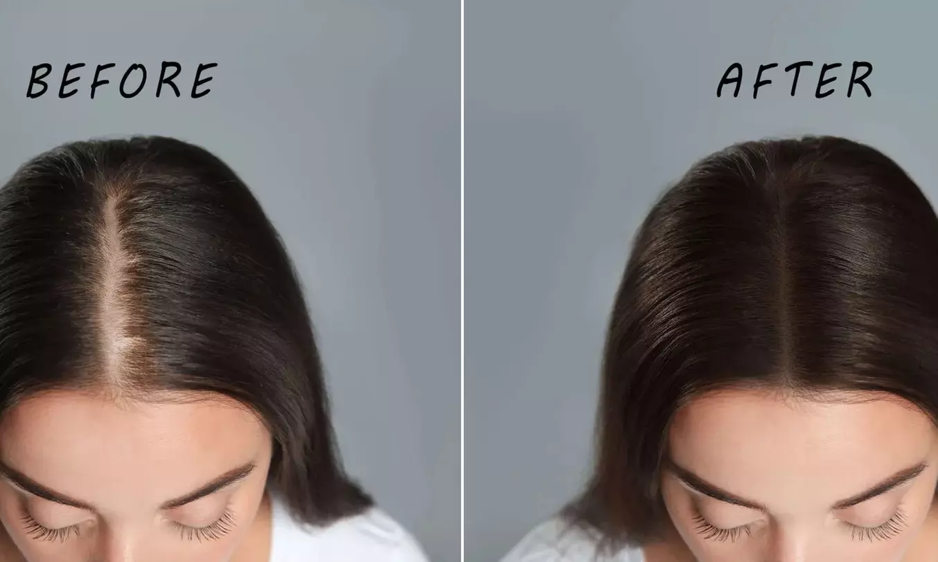 Rejuvenate Your Skin or Restore Your Hair: 1, 2, or 3 PRP Hair Loss or Facial Treatment Sessions (Up to 73% Off) - Second Medium