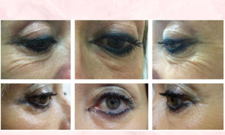 Image 4: PlexR: huidverstrakking zonder snijden