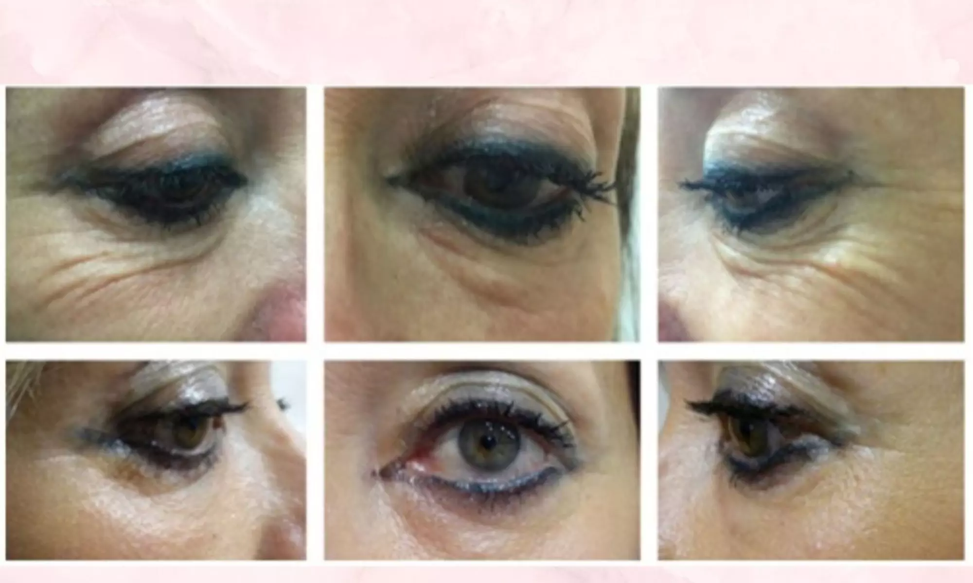 PlexR: huidverstrakking zonder snijden