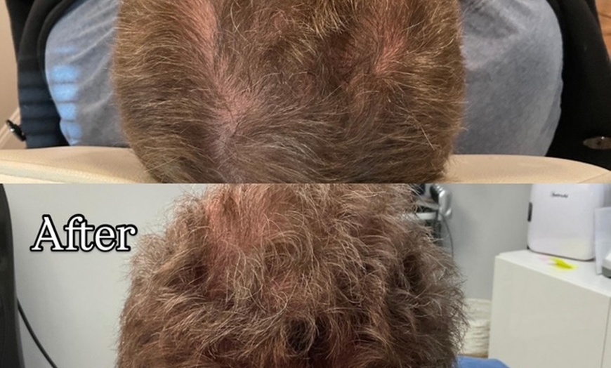 Image 5: Revitalize Thinning Hair w/ Needle-Free Alma TED Sessions