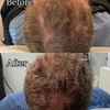 Image 5: Revitalize Thinning Hair w/ Needle-Free Alma TED Sessions