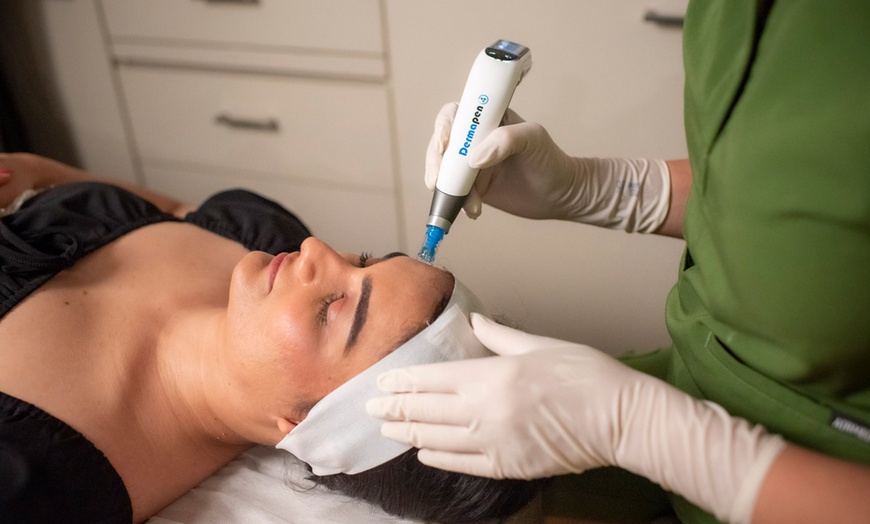 Image 3: Radio Frequency or Dermapen Skin Needling on Face & Neck or More