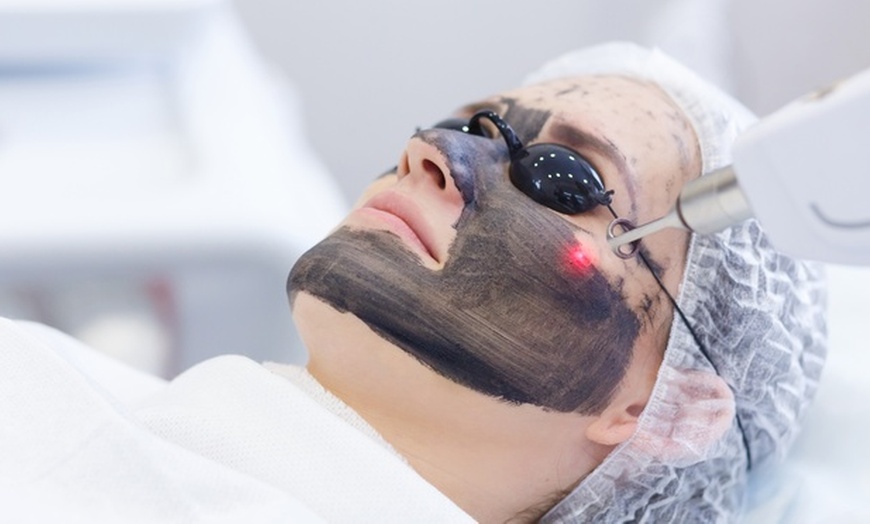 Image 2: Carbon-Peeling / Microneedling / Microneedling + BB-Glow 