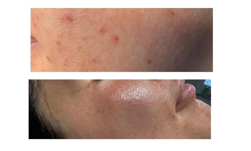 Image 2: Aqua Facial und/oder Microneedling opt. mit Lichttherapie für 1 Person