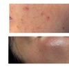 Image 2: Aqua Facial und/oder Microneedling opt. mit Lichttherapie für 1 Person