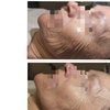 Image 2: HIFU For Smile Line, Jawline & Chin, Full Face with or without Neck 