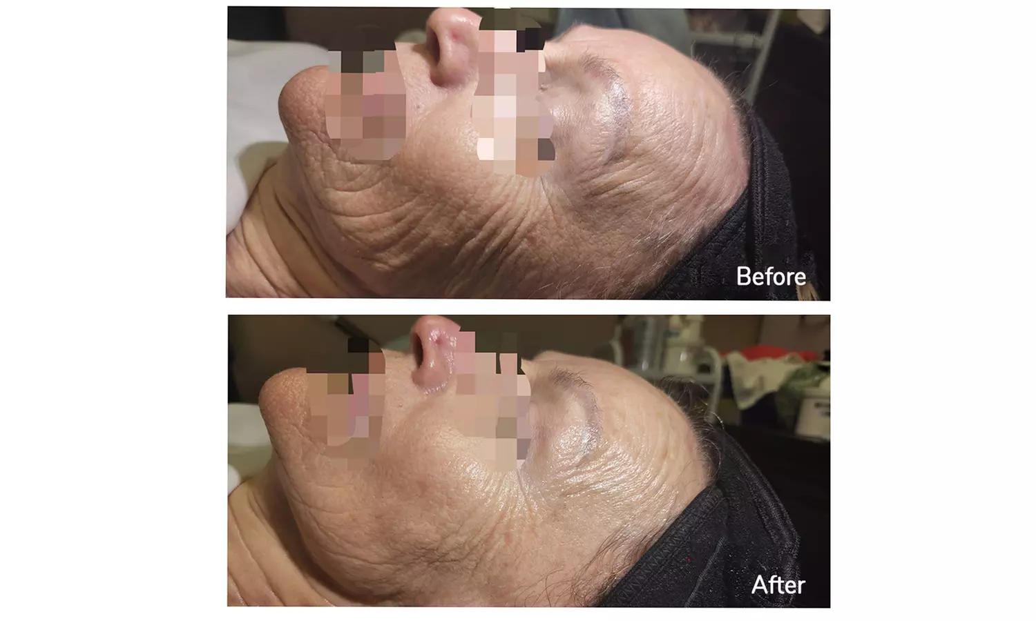 Revitalize with 20,35,60 or 90-Min HIFU For Smile Line, Jawline & Chin, Full Face w/ or w/o Neck Up to  55% Off - Second Medium