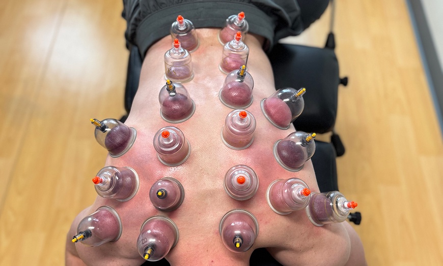 Image 6: Up to 37% Off on Cupping at Navigate Health Chiropractic