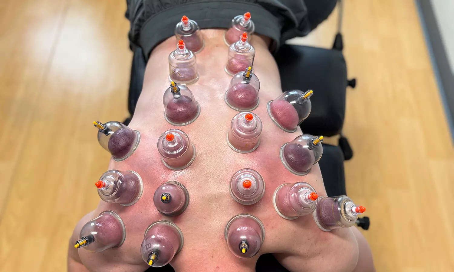 Up to 30% Off on Cupping at Navigate Health Chiropractic