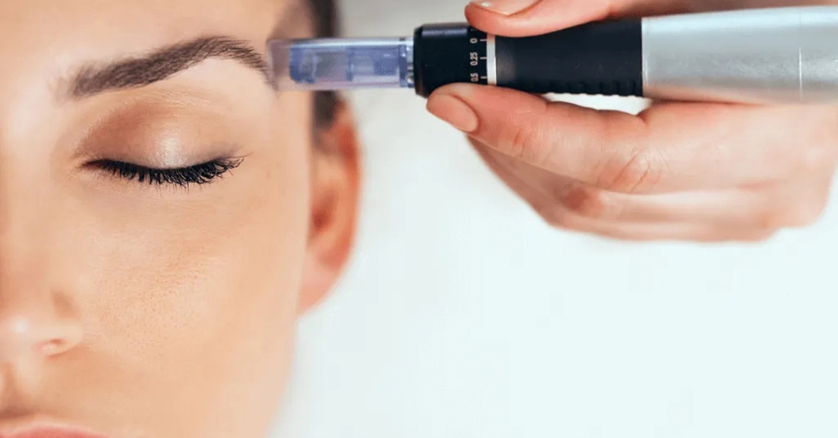Tratamiento facial con Dermapen y exosomas en Granada