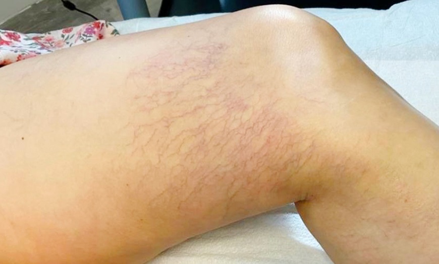 Image 5: Consult, Ultrasound, Vein Removal Injection (10cc) for a 2x2 Area