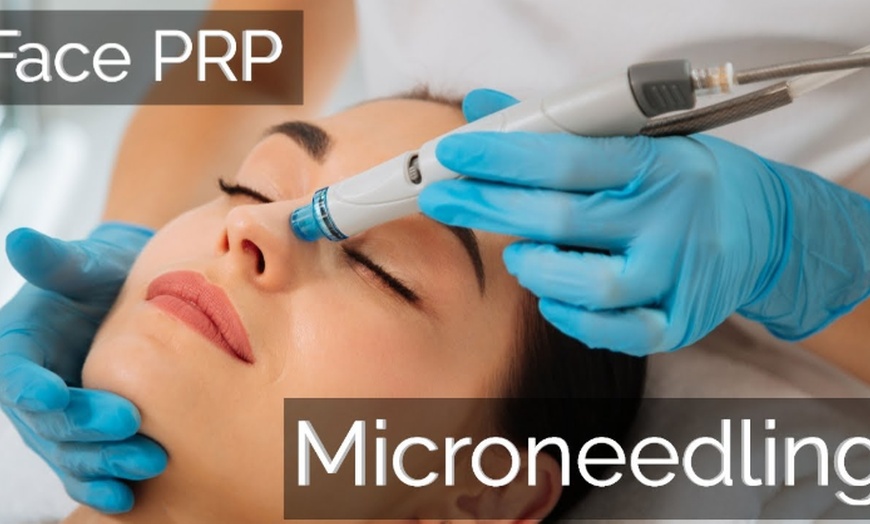 Image 2: Glow with 1 or 3 PRP Facial Treatment with Microneedling 