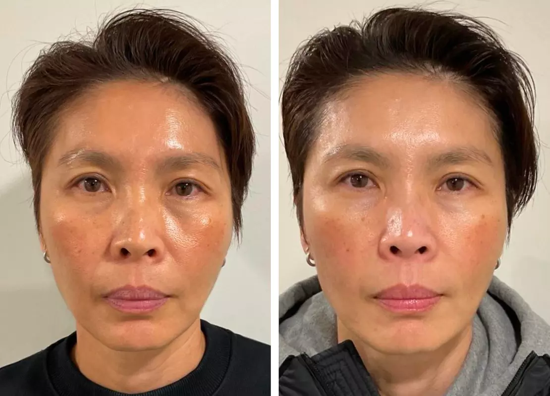 Polynucleotide Skin Rejuvenation for Eyes, Face, or Neck