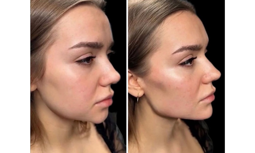 Image 7: Revanesse Versa Dermal Filler: Natural Lip & Facial Enhancement