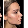 Image 7: Revanesse Versa Dermal Filler: Natural Lip & Facial Enhancement