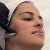 Image 3: Glow with 1 or 3 Visits of 2 ML of Salmon DNA Injections (Full Face)
