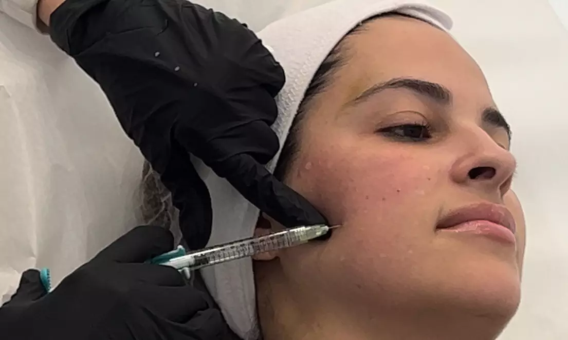 Glow with 1 or 3 Visits of 2 ML of Salmon DNA Injections (Full Face)