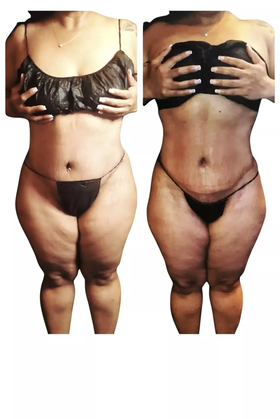 Cosmetic Surgery Aftercare 1 2 Or 3 Packs of 30-Min Recovery Treatment