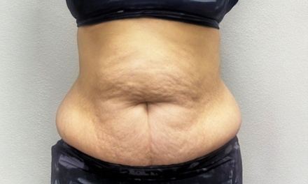 Early Bird: One 60-Minute Body Contouring for One Area (Glutes, Stomach, Arms, or Legs) - Body Temple Self Care Studio