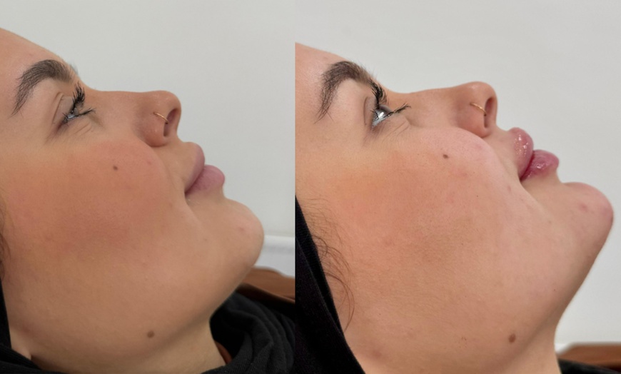 Image 2: Up to 75% off Signature Dermal Filler for Lips & Face - 1ml up to 2ml
