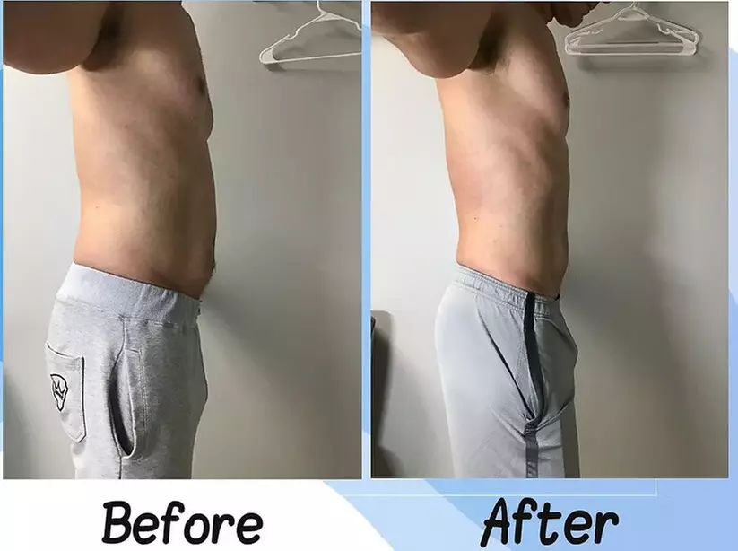 One, Two or Three Fat Freezing Treatments Awaits for a Slimmer You