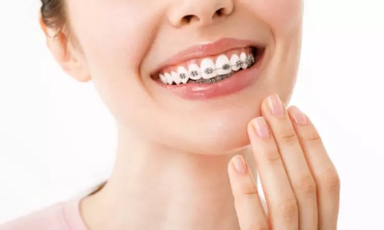 Ortodoncia metálica o estética con 6 meses de tratamiento