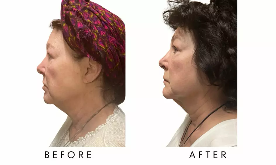 FACE-TITE - Face/Neck Tightening & Contour Lift at Your Sculpt Studio