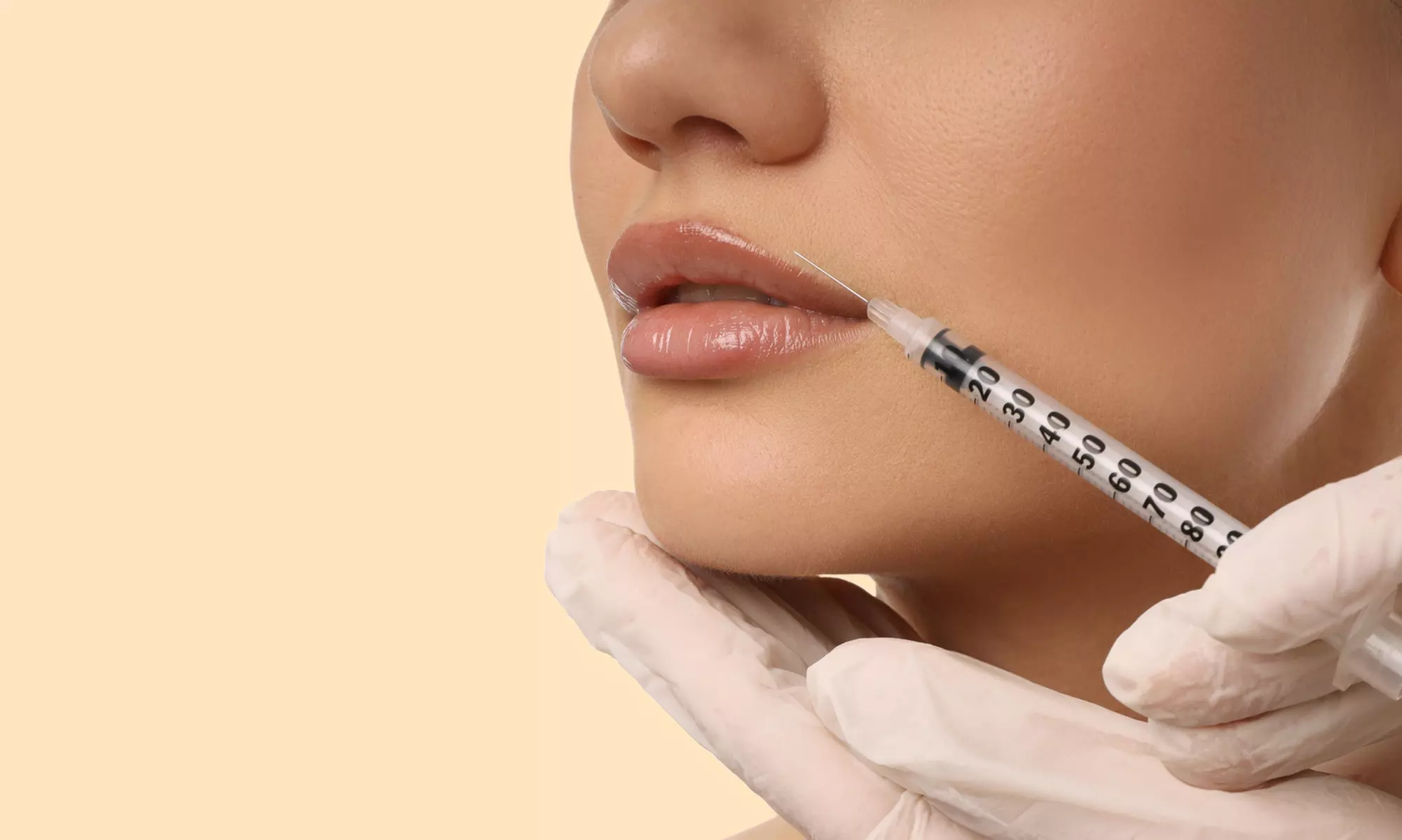 Enhance Your Lips with Half or One Syringe of Versa Lip Filler (Up to 35% Off)