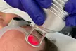 CO2 Skin Resurfacing Treatment: Full-Face/Neck and Décolletage/Tummy at SlimmThicc Aesthetics Spa (upto 70% Off) - Second Medium