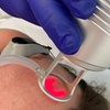 Image 3: CO2 Skin Resurfacing Treatment: Full-Face/Neck and Décolletage/Tummy