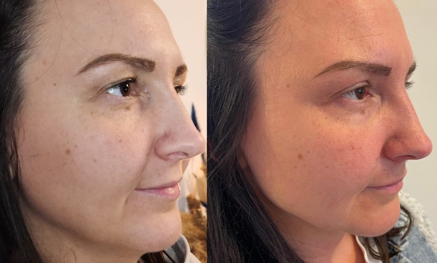 Image 3: Plasmalift: Oberlidstraffung & Lifting mit Skin Corrector für 1 Person