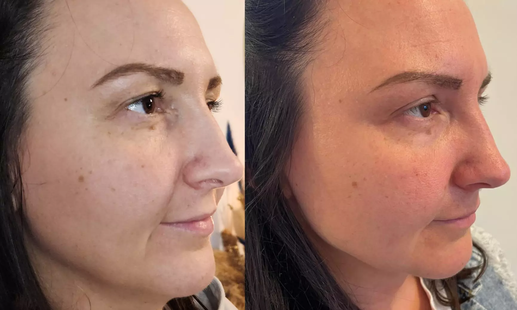 Plasmalift: Oberlidstraffung & Lifting mit Skin Corrector für 1 Person