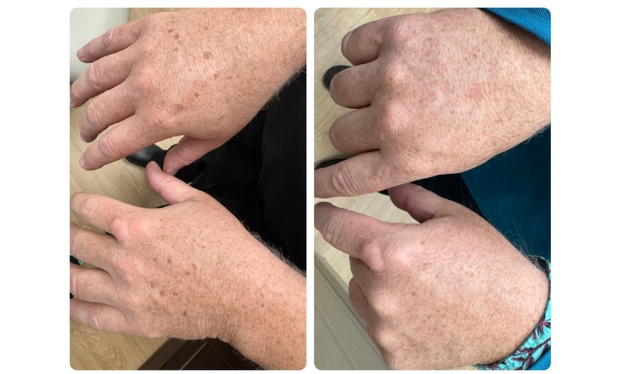Image 7: One or Two Spider Vein/Cluster Removal Treatment with Consultation