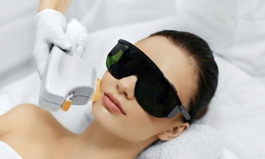 Image 7: IPL, Carbon Laser, RF Lifting or Micro-needling Facial Sessions