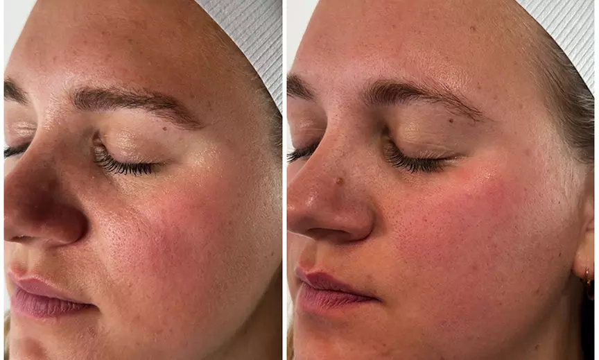 Luxury Massage & Facial Packages with Celluma Light Therapy 