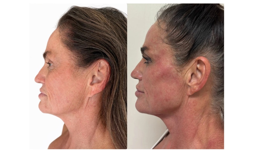 Image 2: Non-Surgical Facelift Treatments