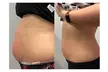 Transform Your Look with Choice of Cavitation Options at Silhouette Aesthetic - Up to 58% Off - Second Medium